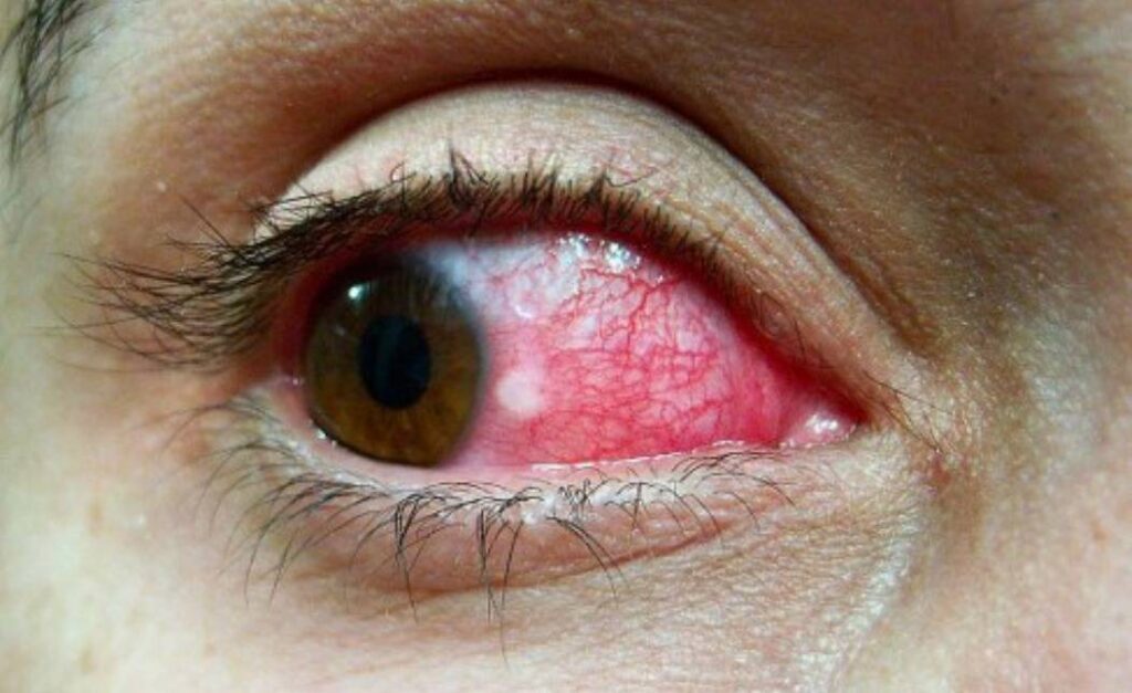after karachi pink eye infection hits lahore 1695210232 8819