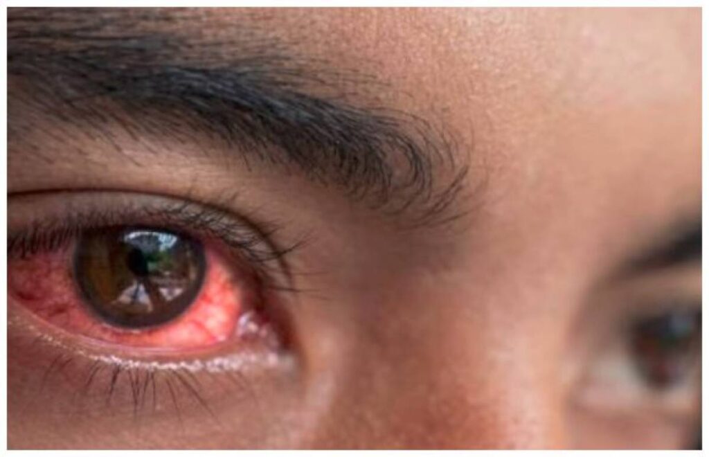 pink eye infection special guidelines issued to airports airlines 1694245427 1496